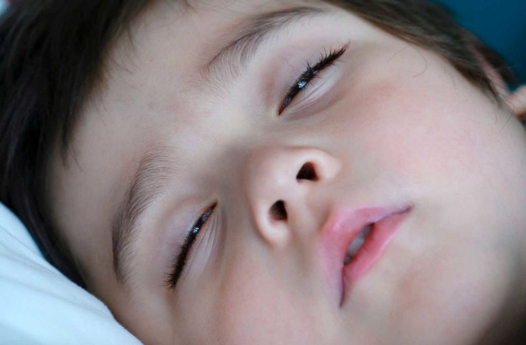 Close-up of a little boy sleeping with his eyes half open.
Nocturnal lagophthalmos is specifically associated with getting dry eyes overnight.