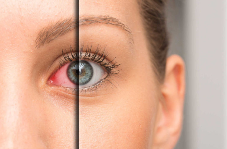 Can Contacts Cause Dry Eyes? Sarnia In Focus Eyecare