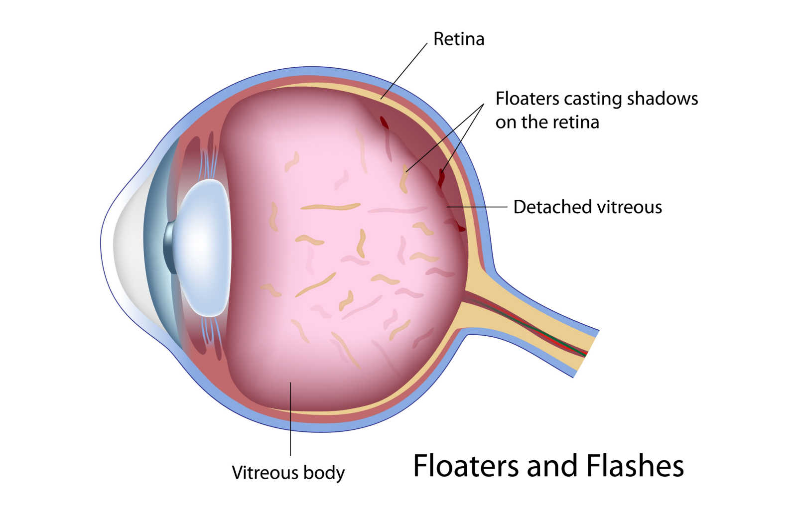 Graphical cross section of an eye showing the detached vitreous and floaters casting shadows on the retina.